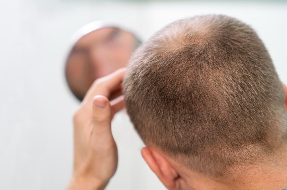 Hair Transplantation.. Restoring Confidence and Natural Beauty