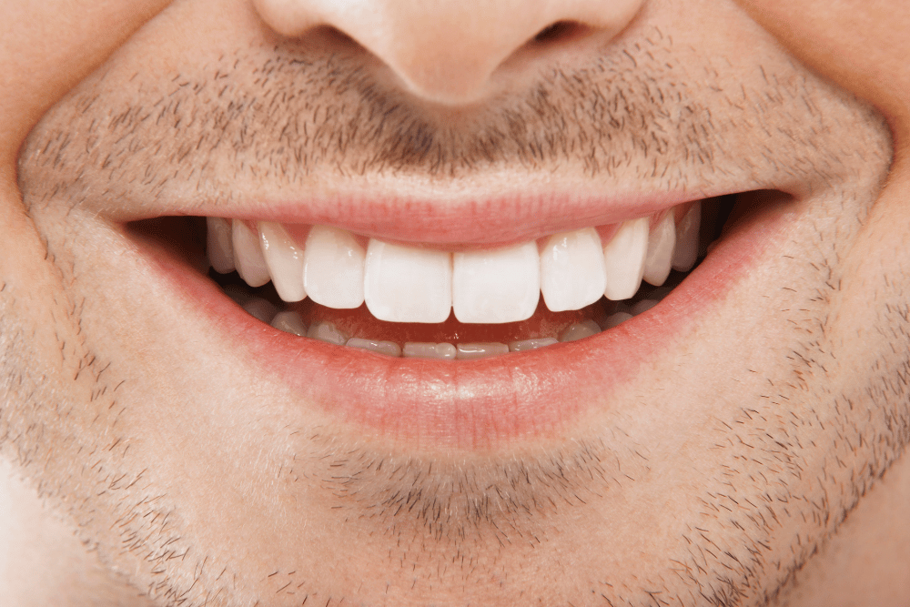 تجميل الأسنان بدون تقويم