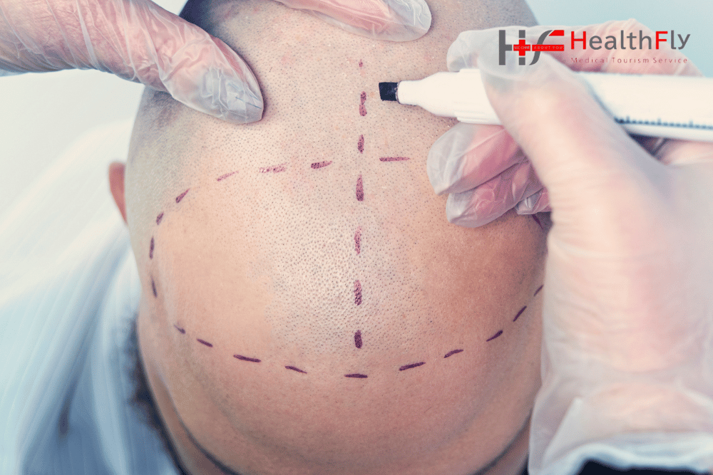 كل ما تحتاج معرفته عن زراعة الشعر في تركيا